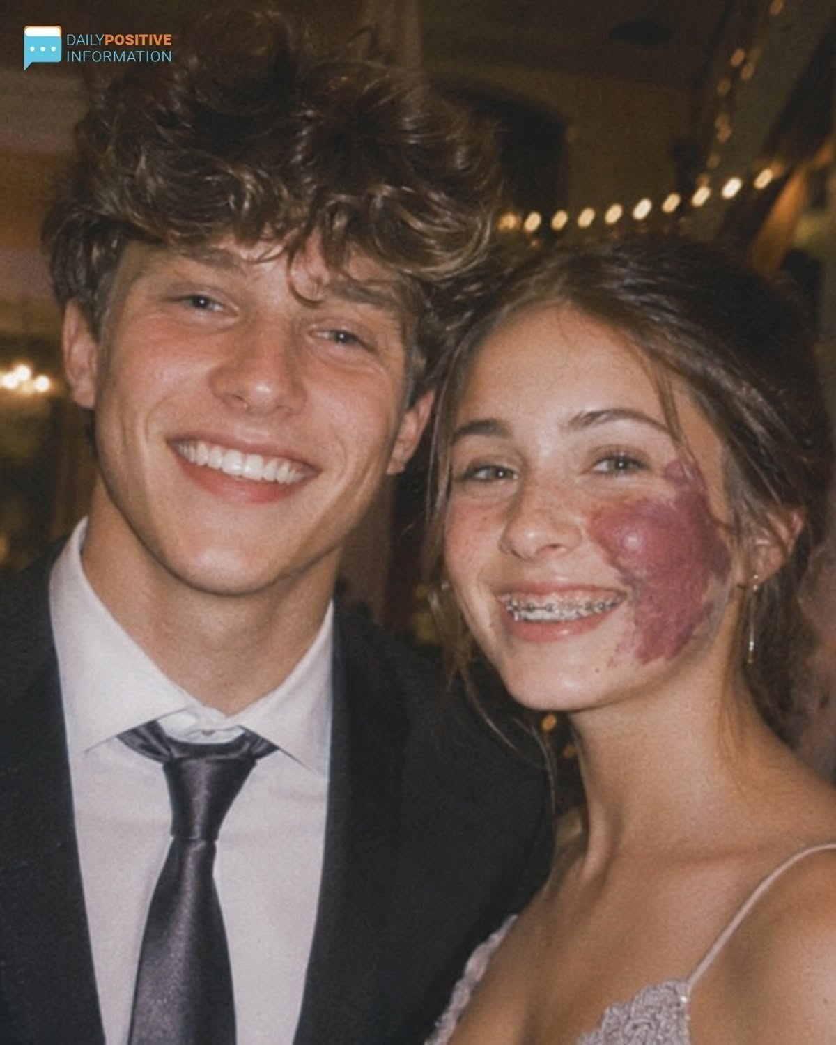 Off The Record Only One Boy Asked Me To Prom Because Of My Birthmark—Until An Officer Walked In