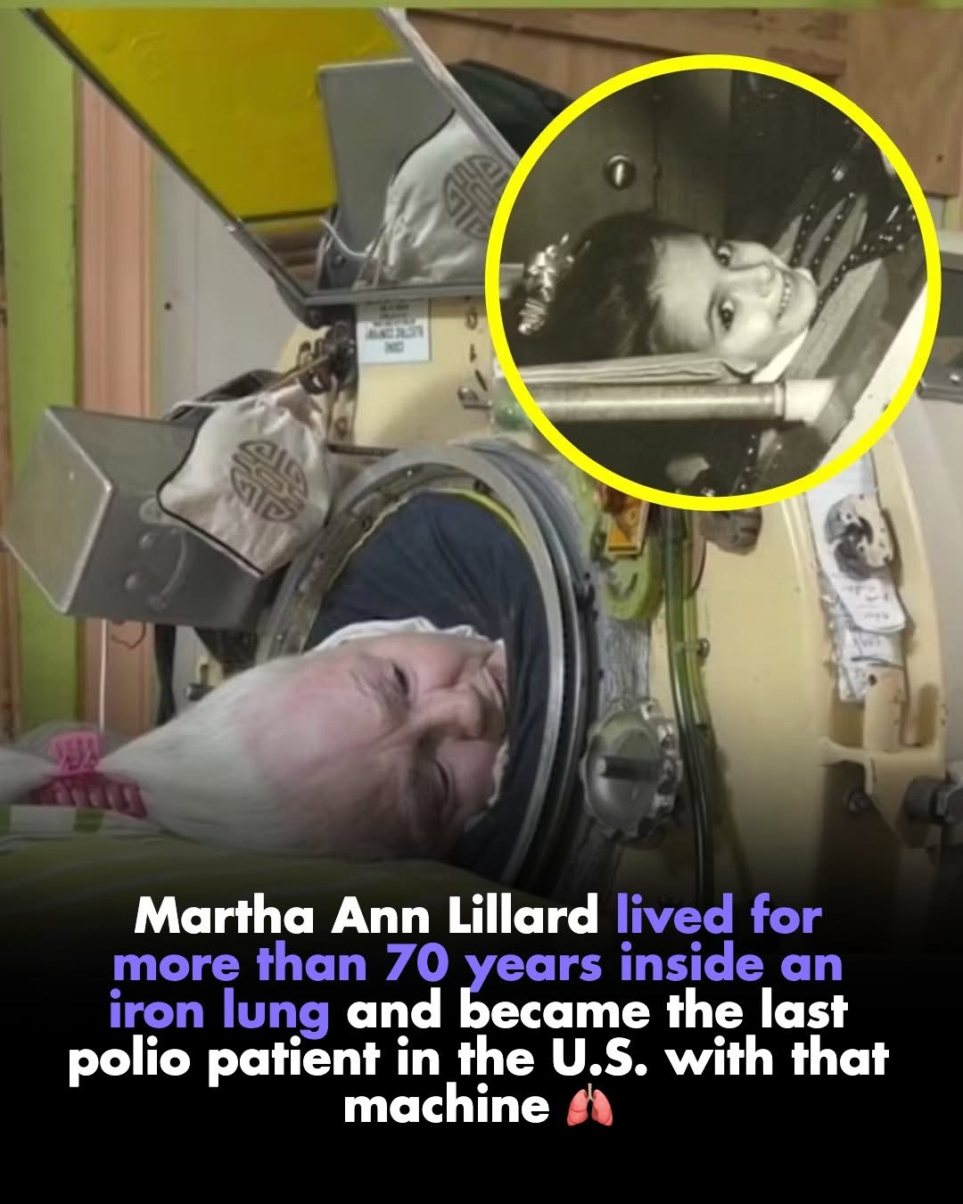 Martha Ann Lillard lived more than 70 years inside an iron lung and became the last polio patient in the U.S.z with that machine 🫁
