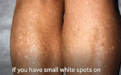Why do I get white spots on my skin in the summer and how can I treat them? A dermatologist answers