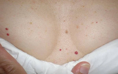 What are the red spots that appear on the skin?