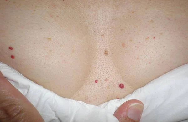 What are the red spots that appear on the skin?